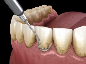 روش جرمگیری دندان