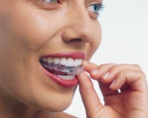 ارتودنسی نامرئی یا اینویزیلاین