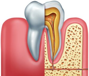 درمان ریشه | عصب کشی دندان