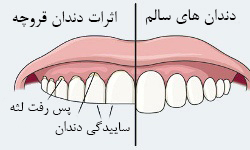 علائم دندان قروچه