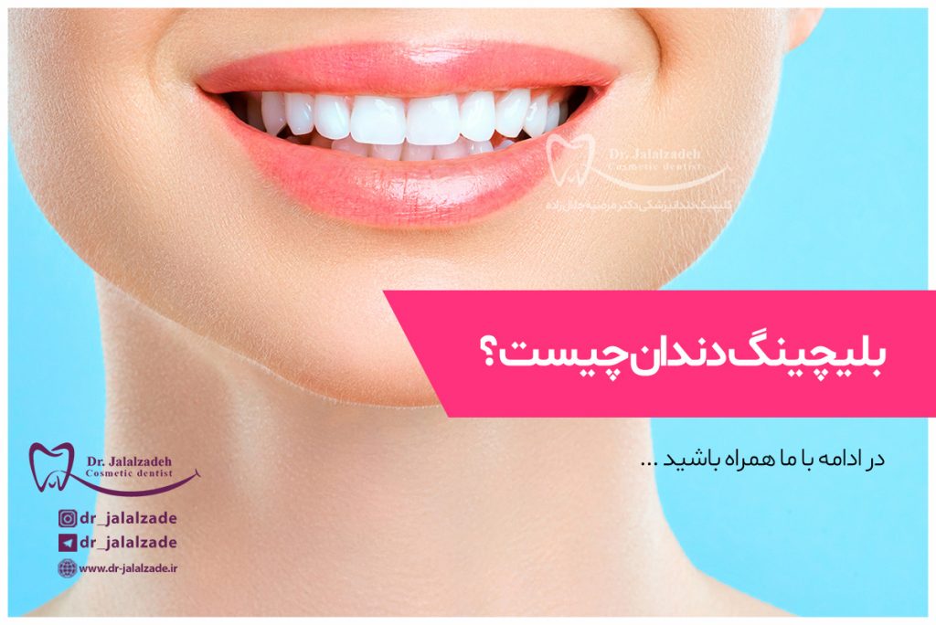 بلیچینگ دندان چیست؟
