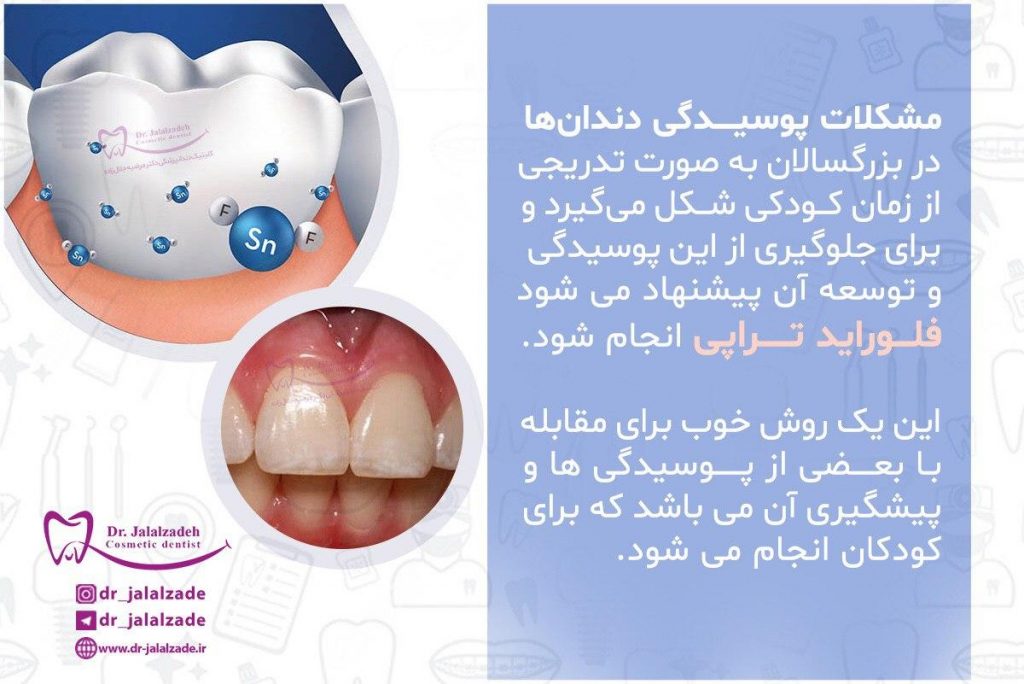 فلوراید تراپی چیست